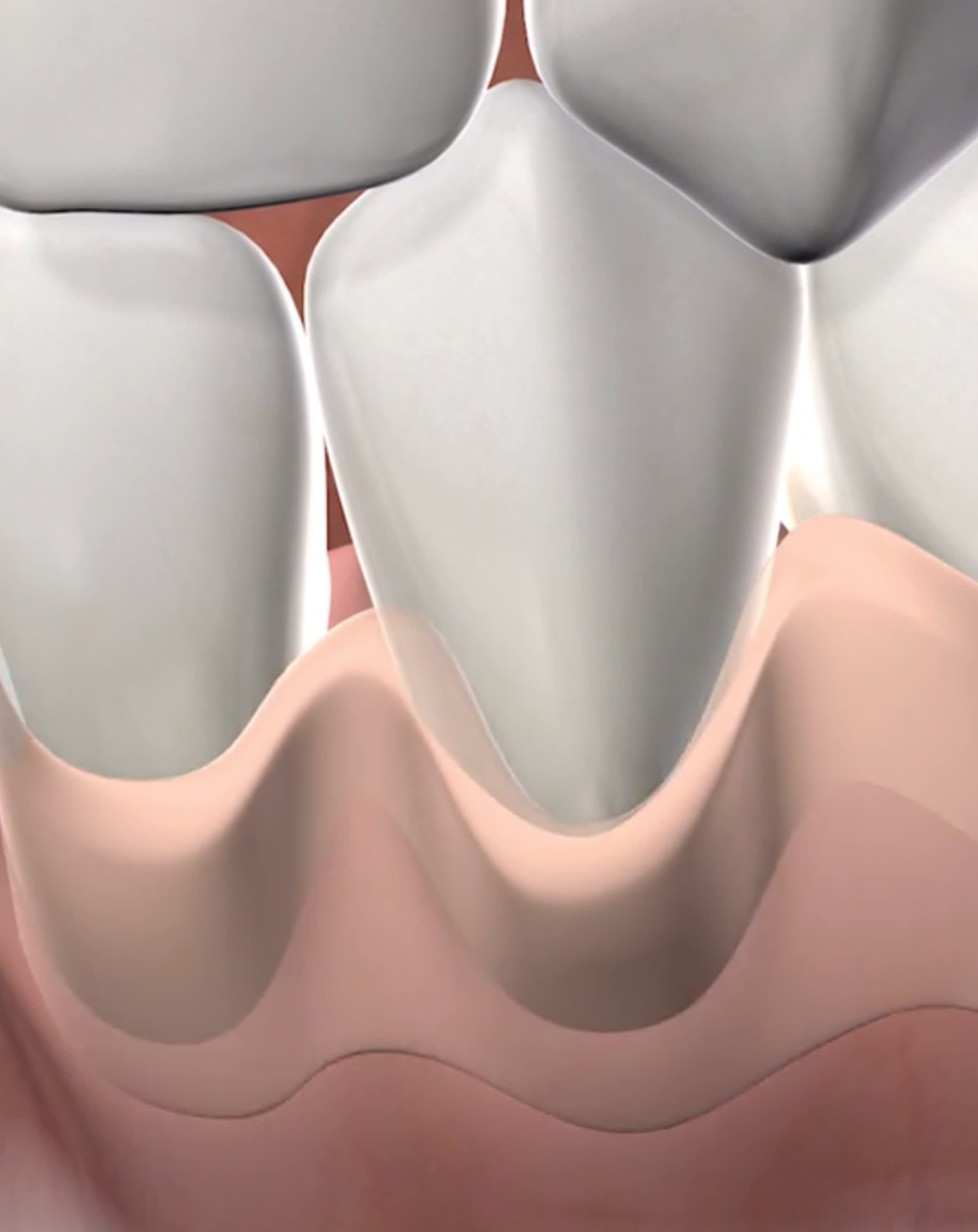 Procedure  soft tissue grafting  mobile
