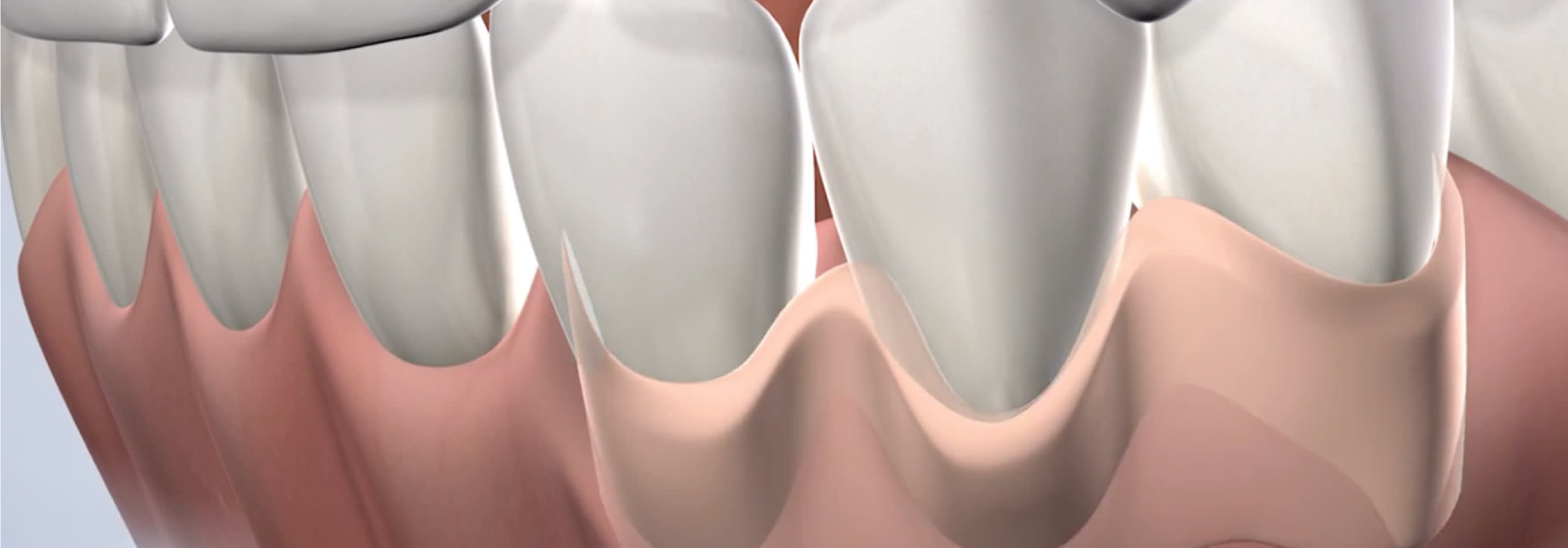 Procedure soft tissue grafting  desktop