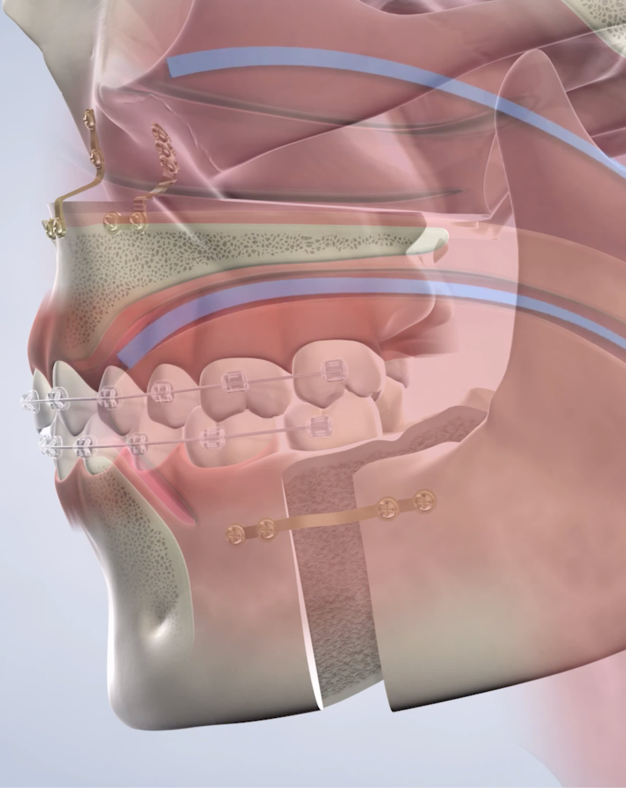 Sleep apnea procedure mobile